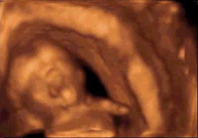 fetal yawning 13 weeks