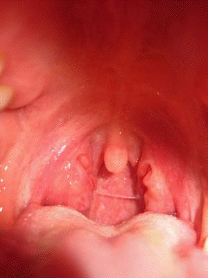tonsillar