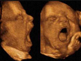 fetal-yawn