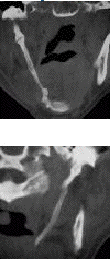 calcified.lig