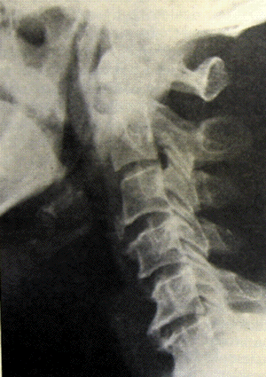 fracture.stylohyoid.bone