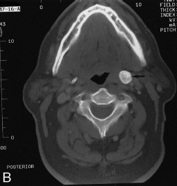 calcified-stylohyoid