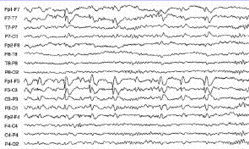 eeg