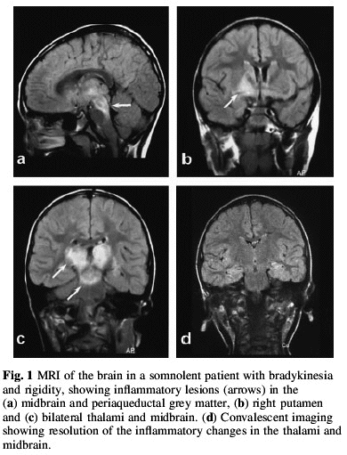 encephalitis