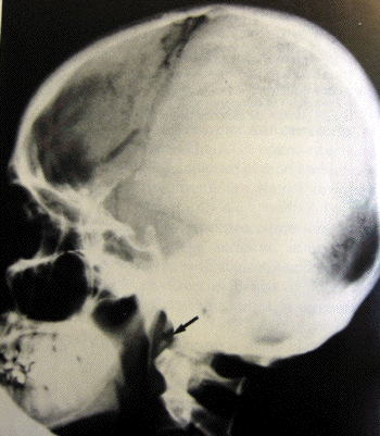 stylohyoid