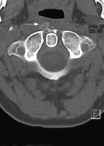 retropharyngitis tendinitis