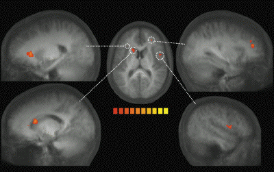 auditory contagion