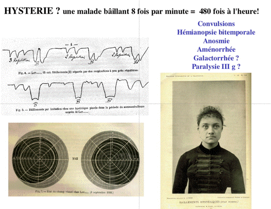 baillements hystériques