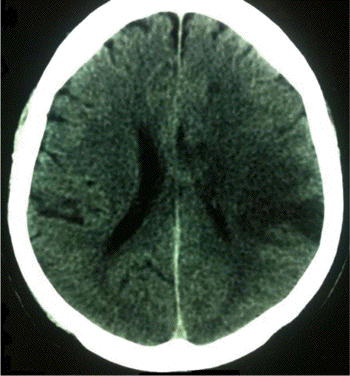 parakinesia brachialis oscitans