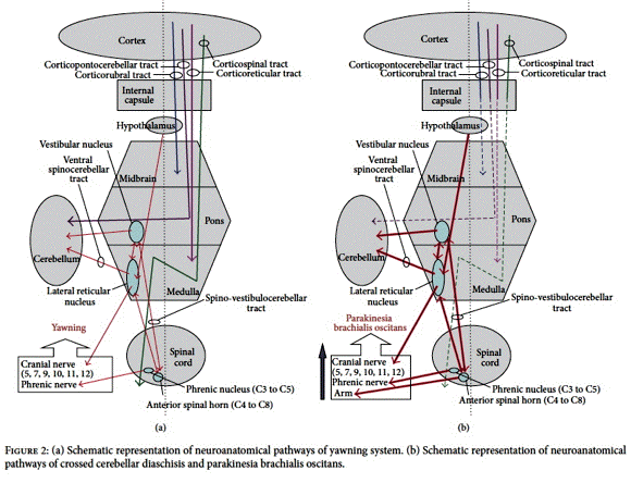 parkinesia brachialis oscitans