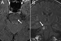 avc.brainstem