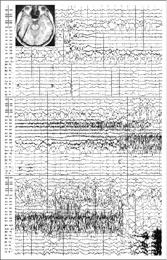 eeg