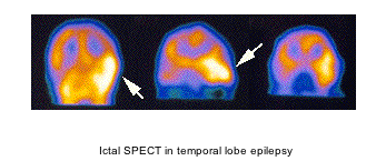 ictal spect