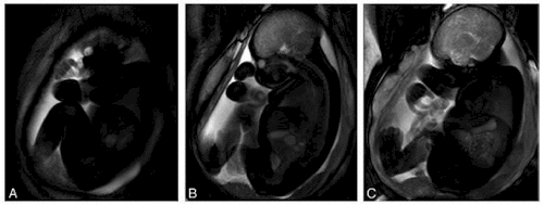 fetal biomechanic