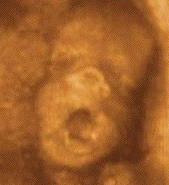 fetal yawn