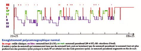 polysomnographie